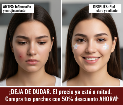 Parches para Acné en Forma de Estrella – 178 Unidades de Cuidado Divertido y Efectivo